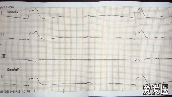 和常规不一样的死亡心电图