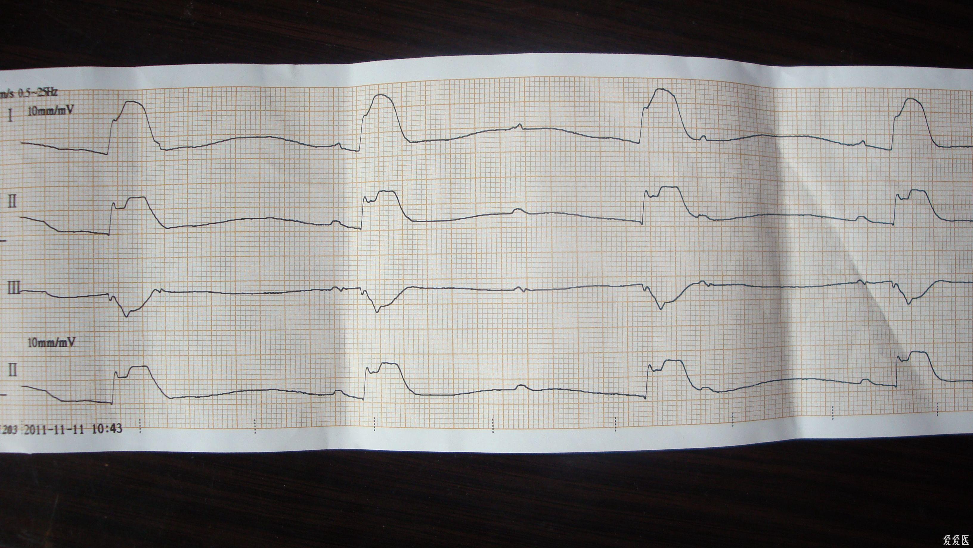 和常规不一样的死亡心电图