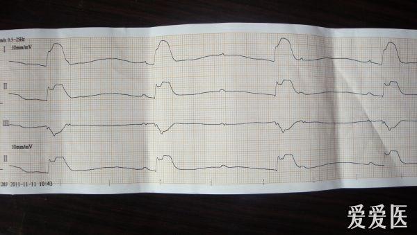 和常規不一樣的死亡心電圖,怎麼下診斷?