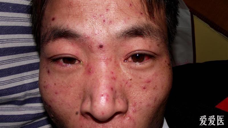 住院病人诊断不明(目前大家一致同意:白塞氏病-良版12.3)