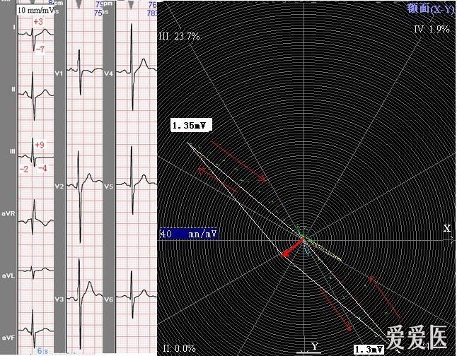 心电图右轴图片