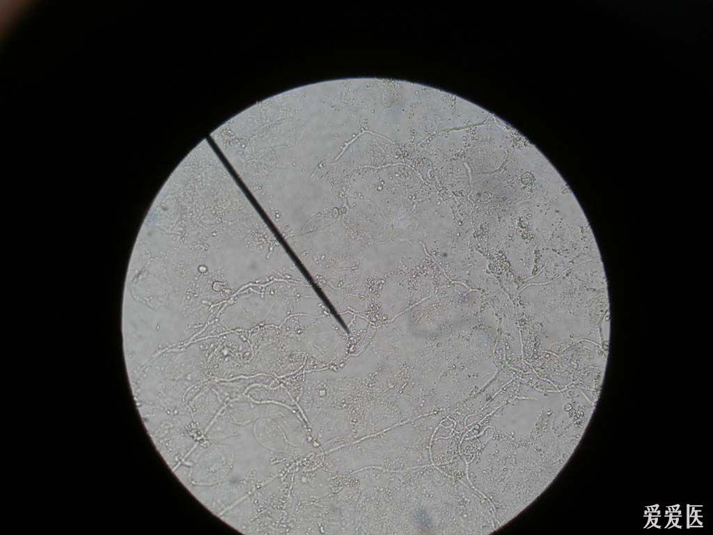 典型病例欣赏:镜下真菌.
