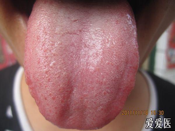 白带多粘色黄有异味,头偶尔有点晕,腰酸,舌边红有牙齿印,舌头前面有