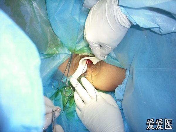 肛裂手术姿势图片图片