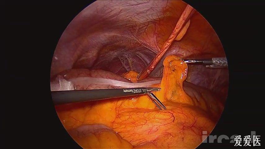 高清[websurg]完全性腹腔镜右半结肠腺癌切除术