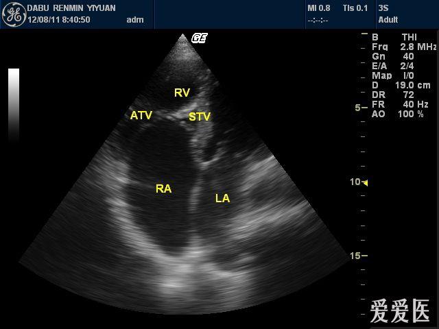 三尖瓣瓣叶超声解剖图片