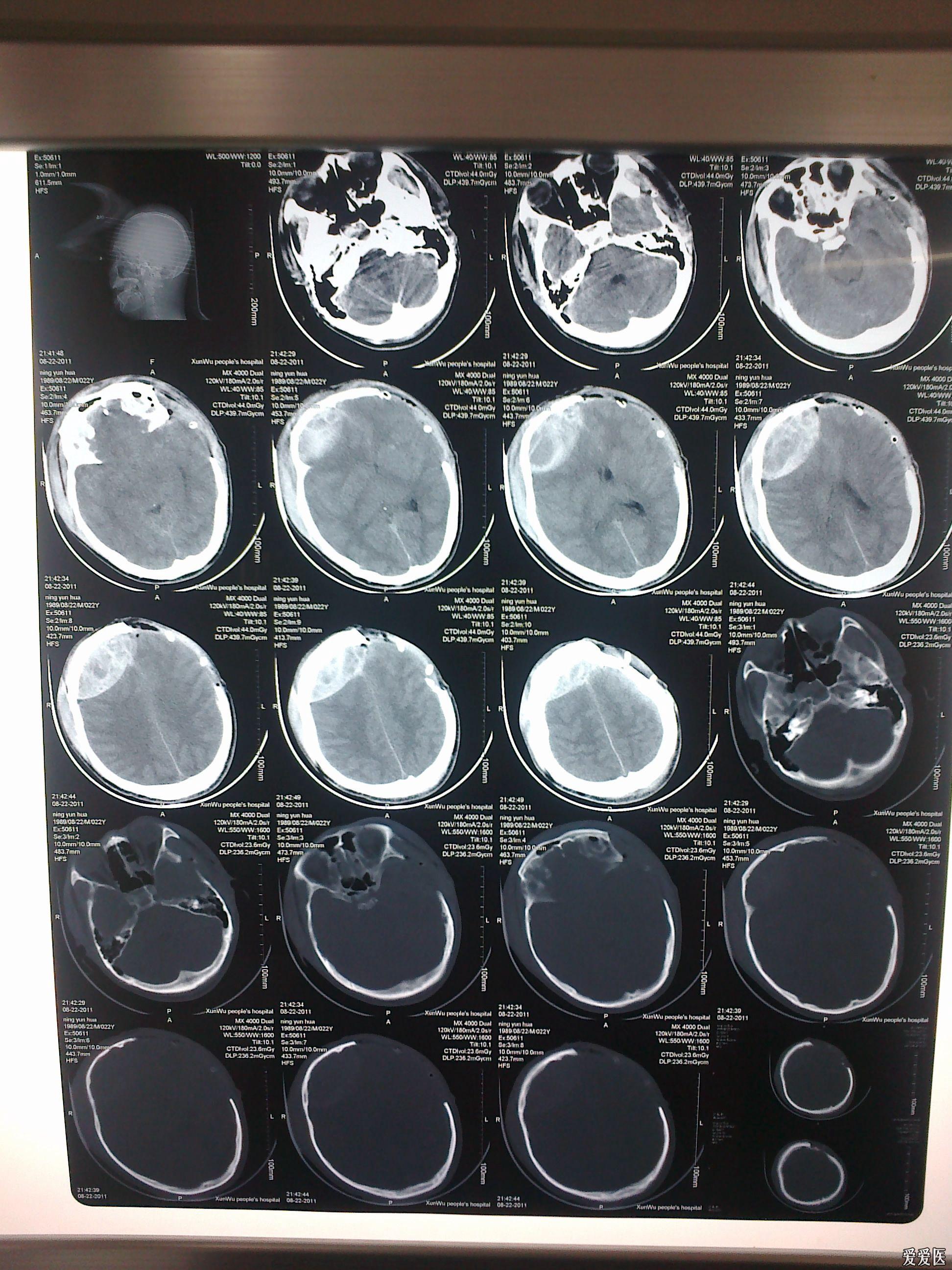 一例重度颅脑外伤患者的两面三刀