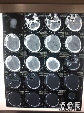 一例重度颅脑外伤患者的两面三刀