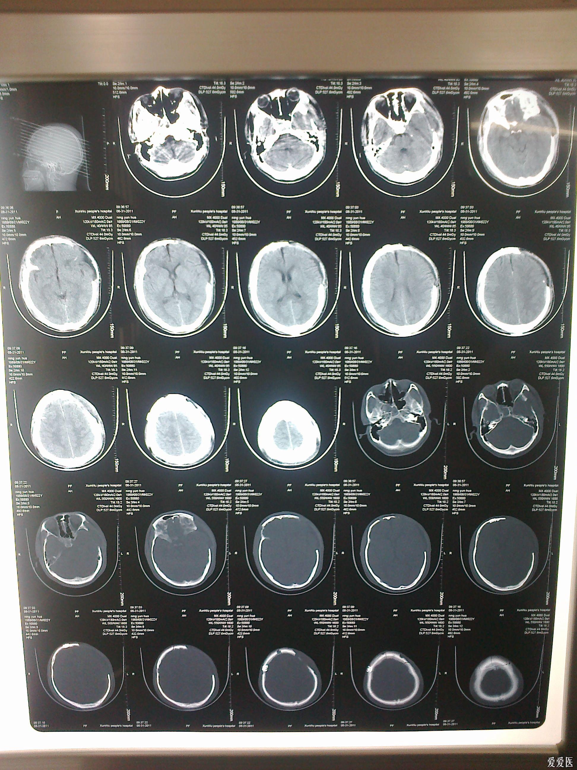 雙側瞳孔約3mm大小,對光反射遲鈍,行ct掃描後半小時出現左瞳孔散大,對