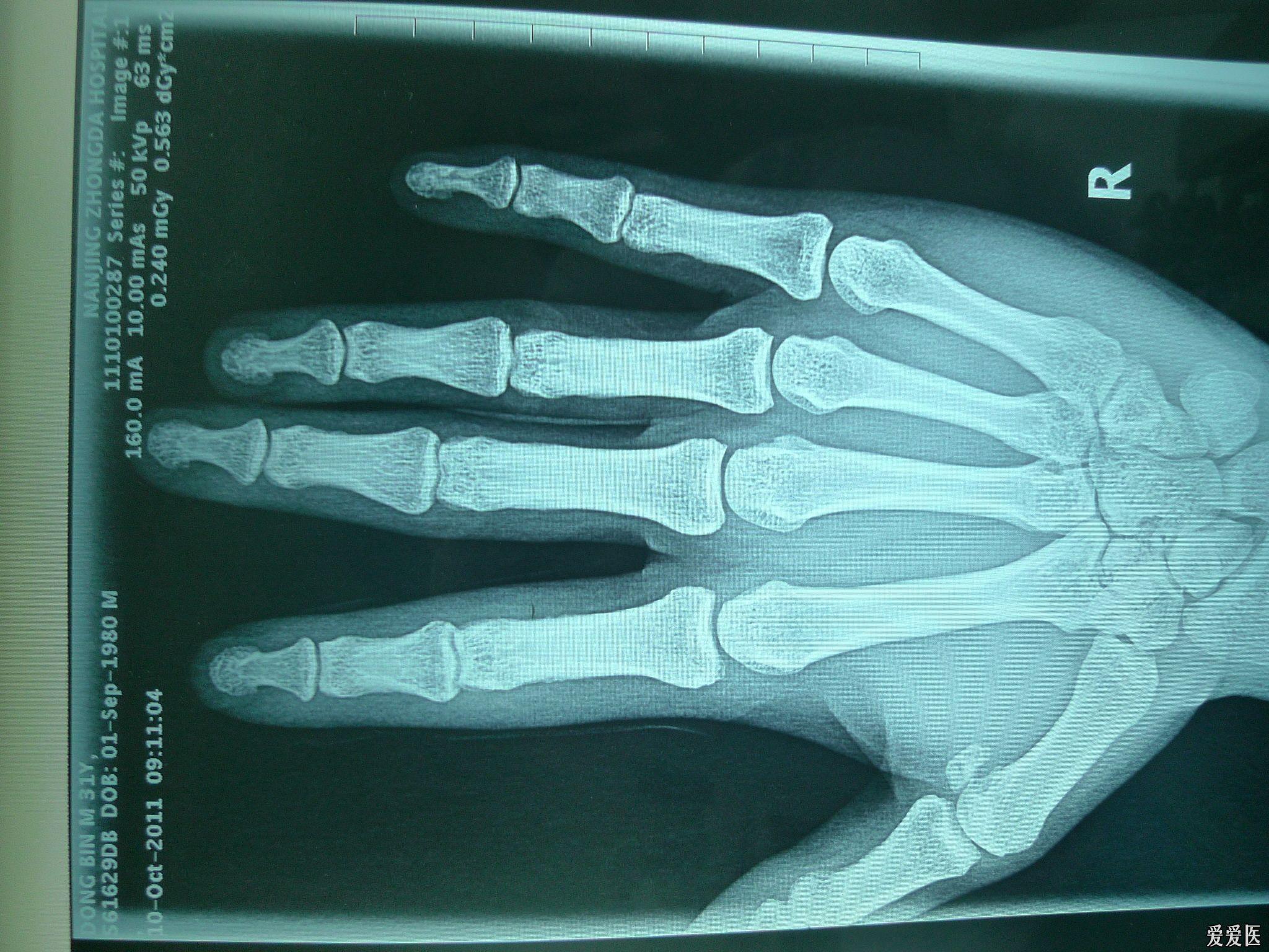 右手食指外伤性脱臼三个月了,手指还不能正常弯曲