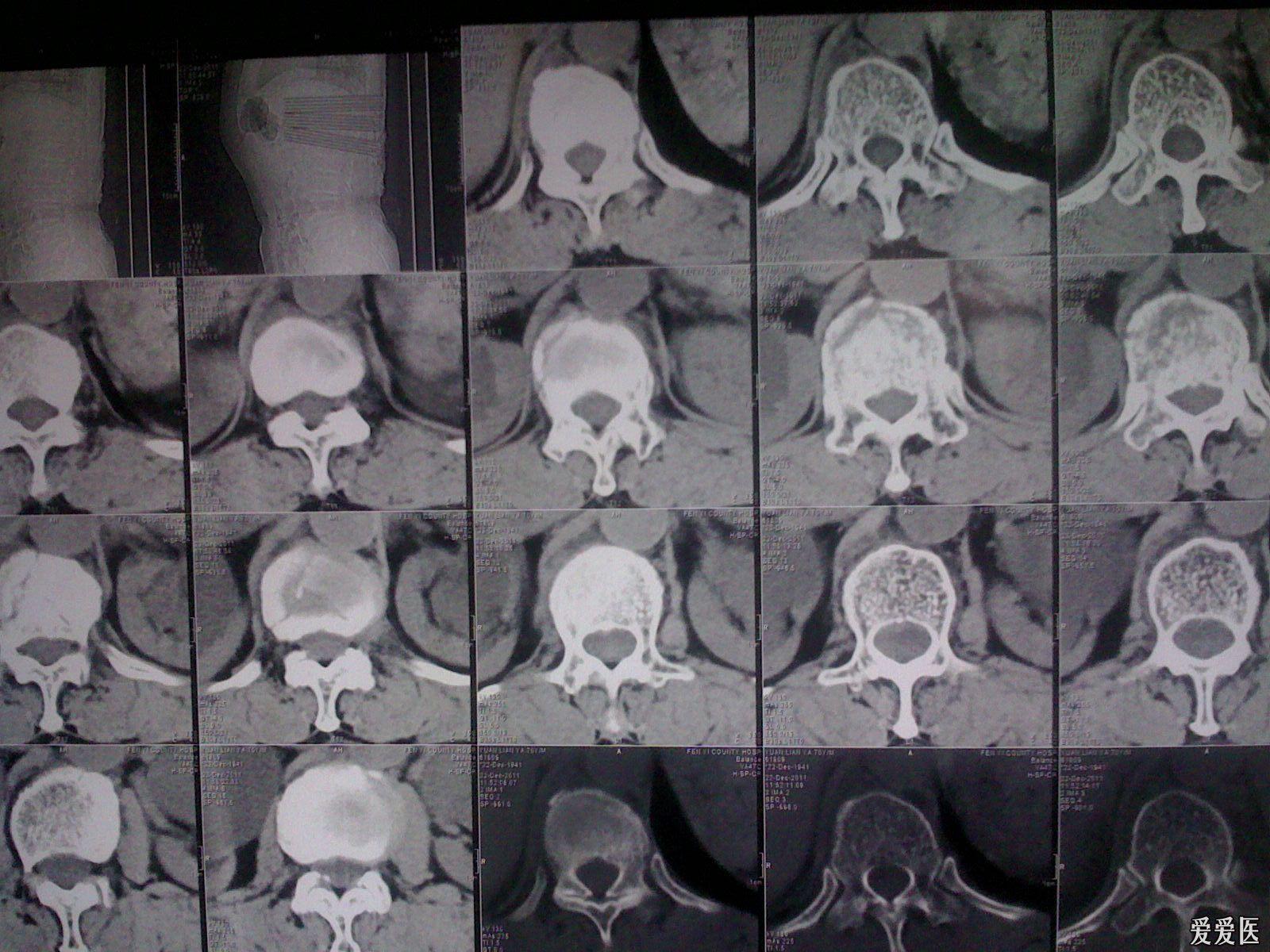 一个t12椎体压缩性骨折并椎管狭窄的病人