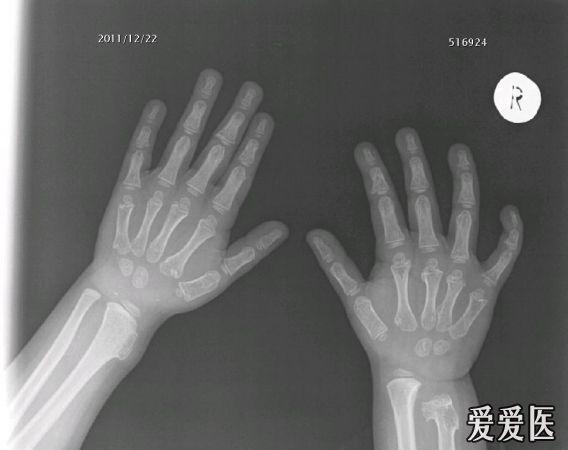 手骨骺线图片