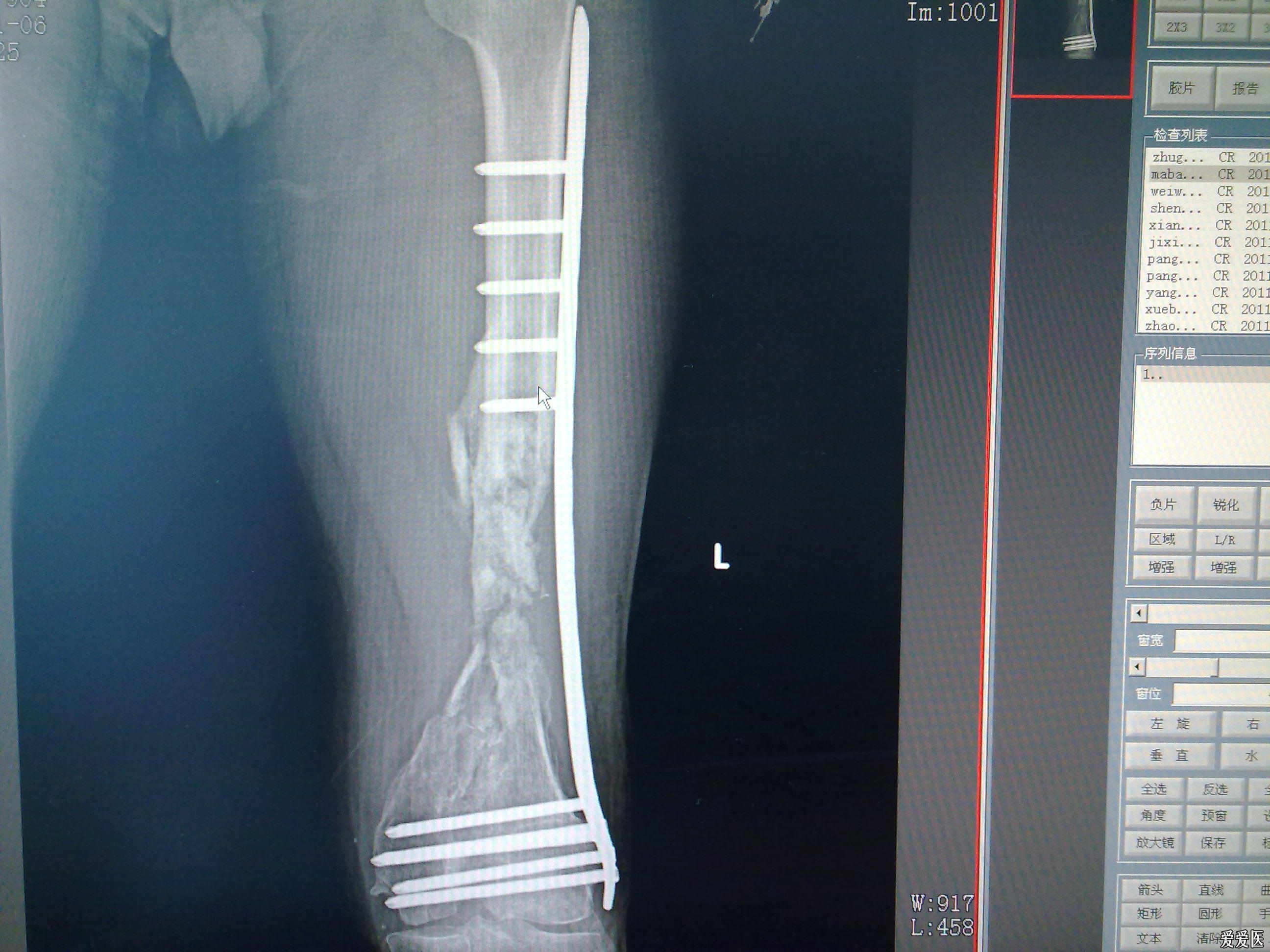 股骨粉碎性骨折钢板固定六月后愈合不佳
