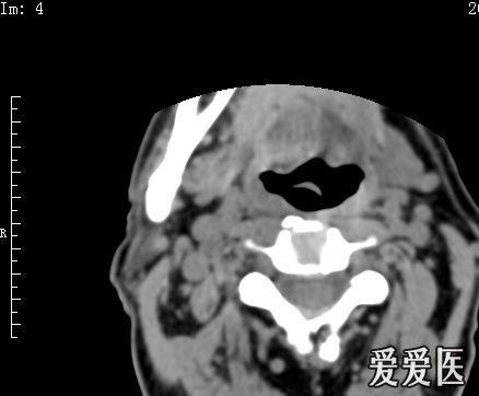 左侧杓会厌皱襞增厚,左侧梨状窝变小,有什么样的意义呢?