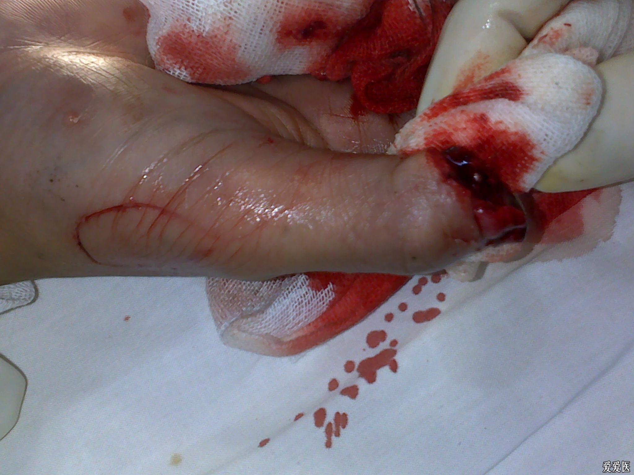 手指出血割伤图片