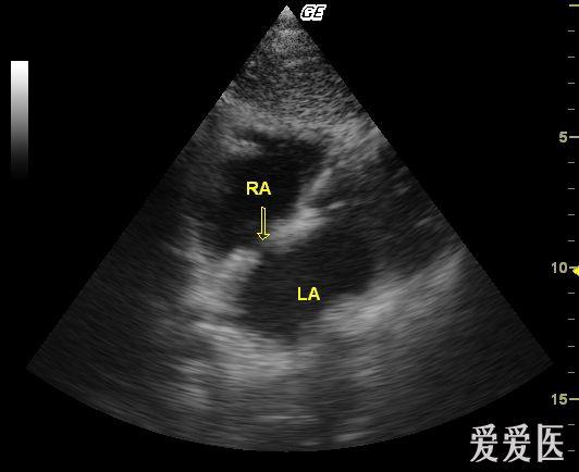 卵圆孔未闭 - 超声医学讨论版 - 爱爱医医学论坛 - 爱爱医医学网