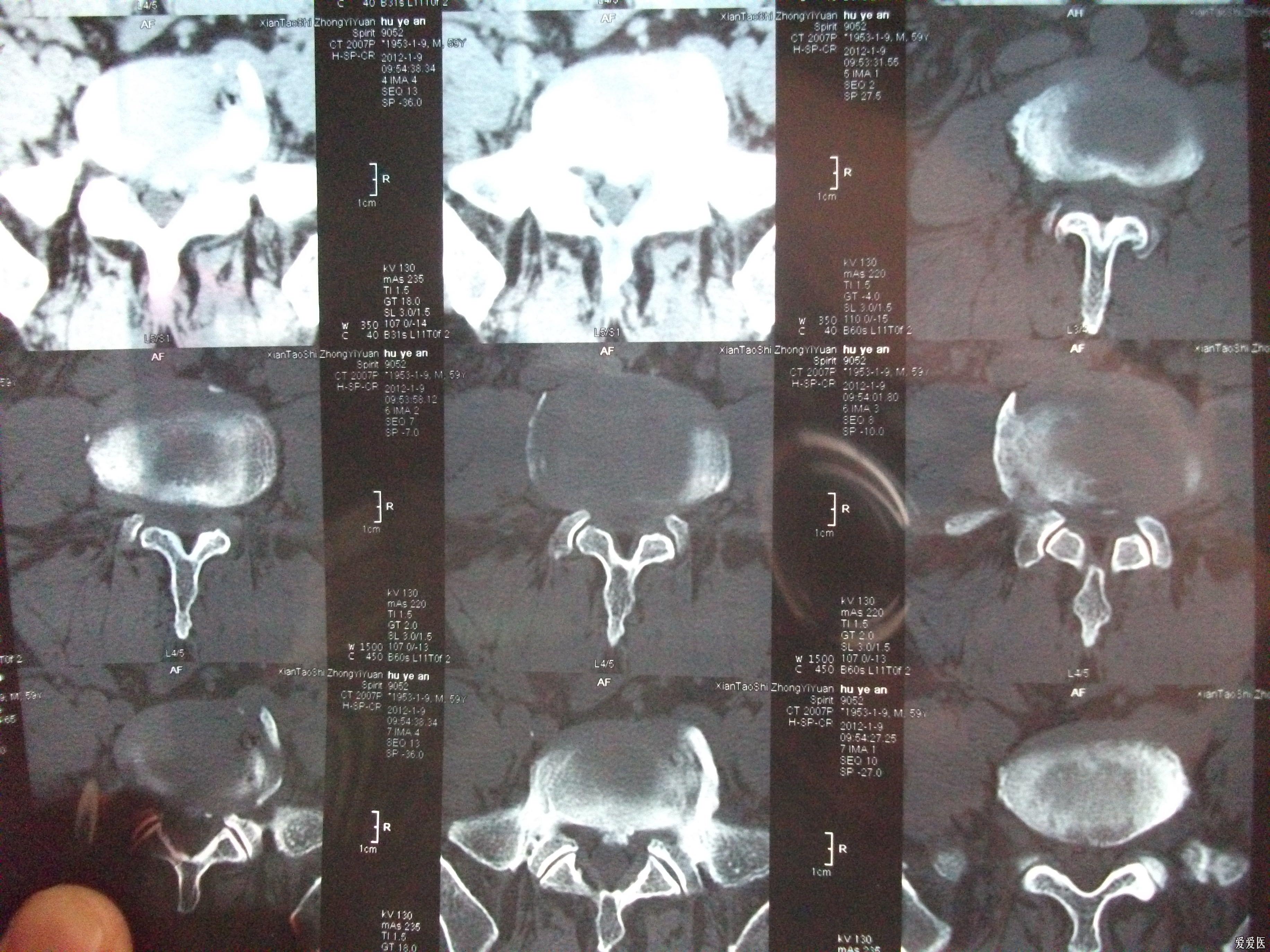 门诊ct医保能报销吗 医保ct
