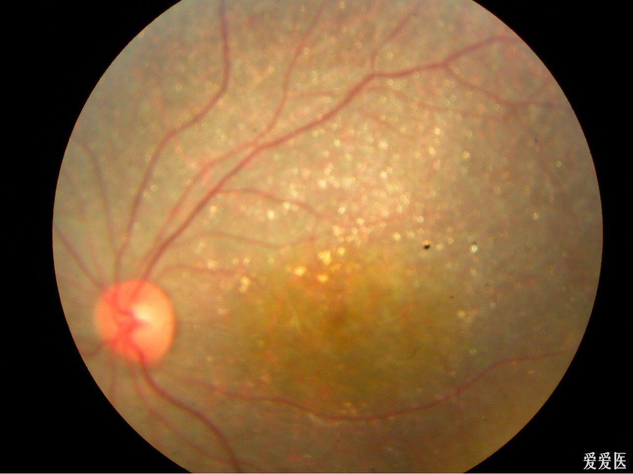 视网膜病变的症状图片图片