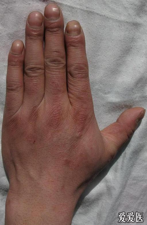 尿毒症手指甲图片图片