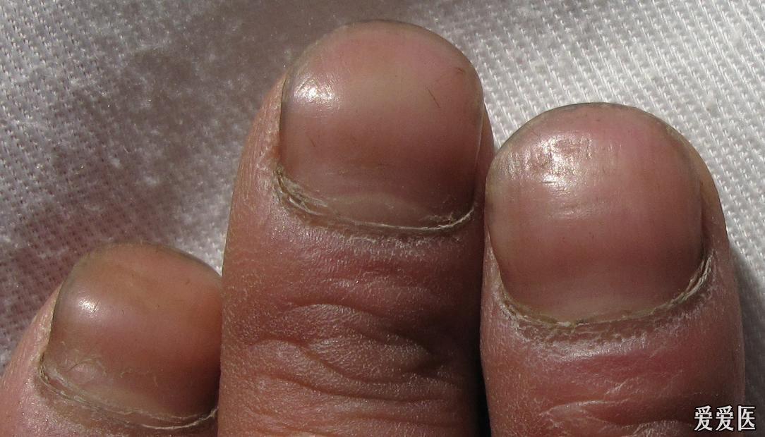 指甲变形