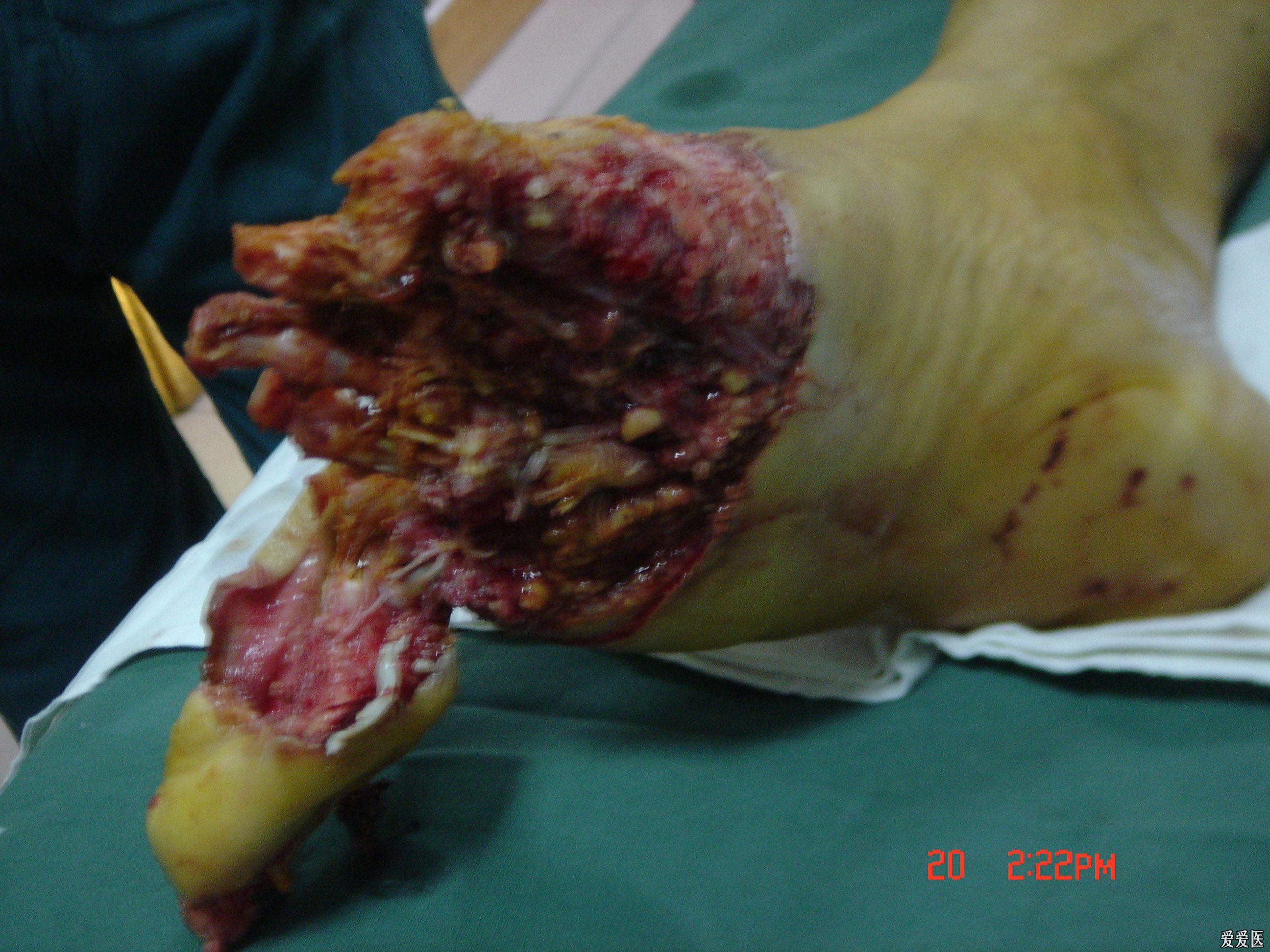 前足皮肤软组织缺损伤