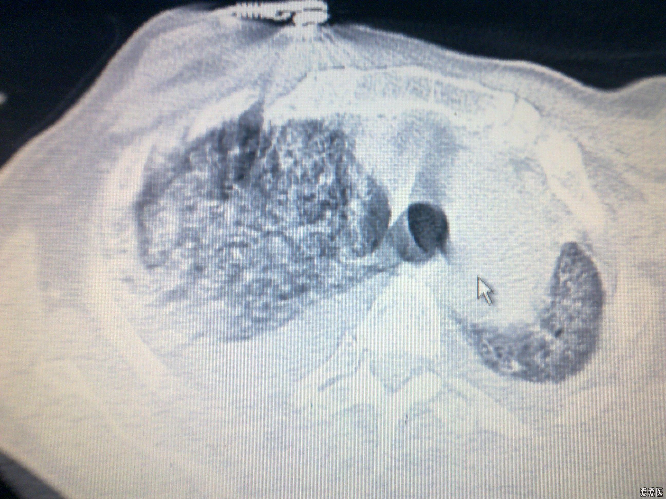 该患者肺出血的原因