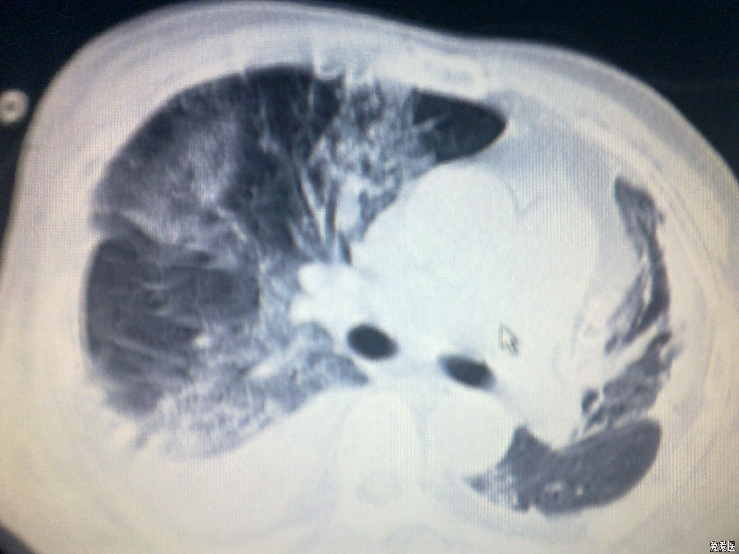 肺淤血ct表现图片图片