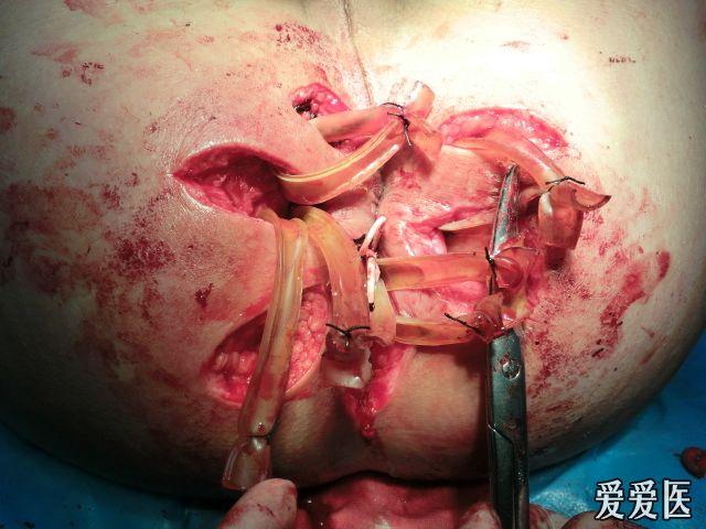 肛周脓肿术后10天图片图片