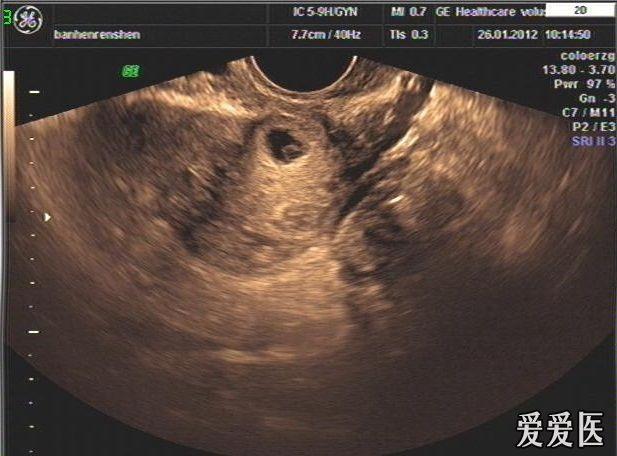 这是我这个月见到的第二例了切口妊娠了,不知道和手术有