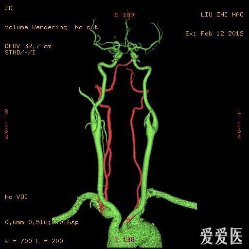 頸腦部cta欣賞一例---椎動脈變異.