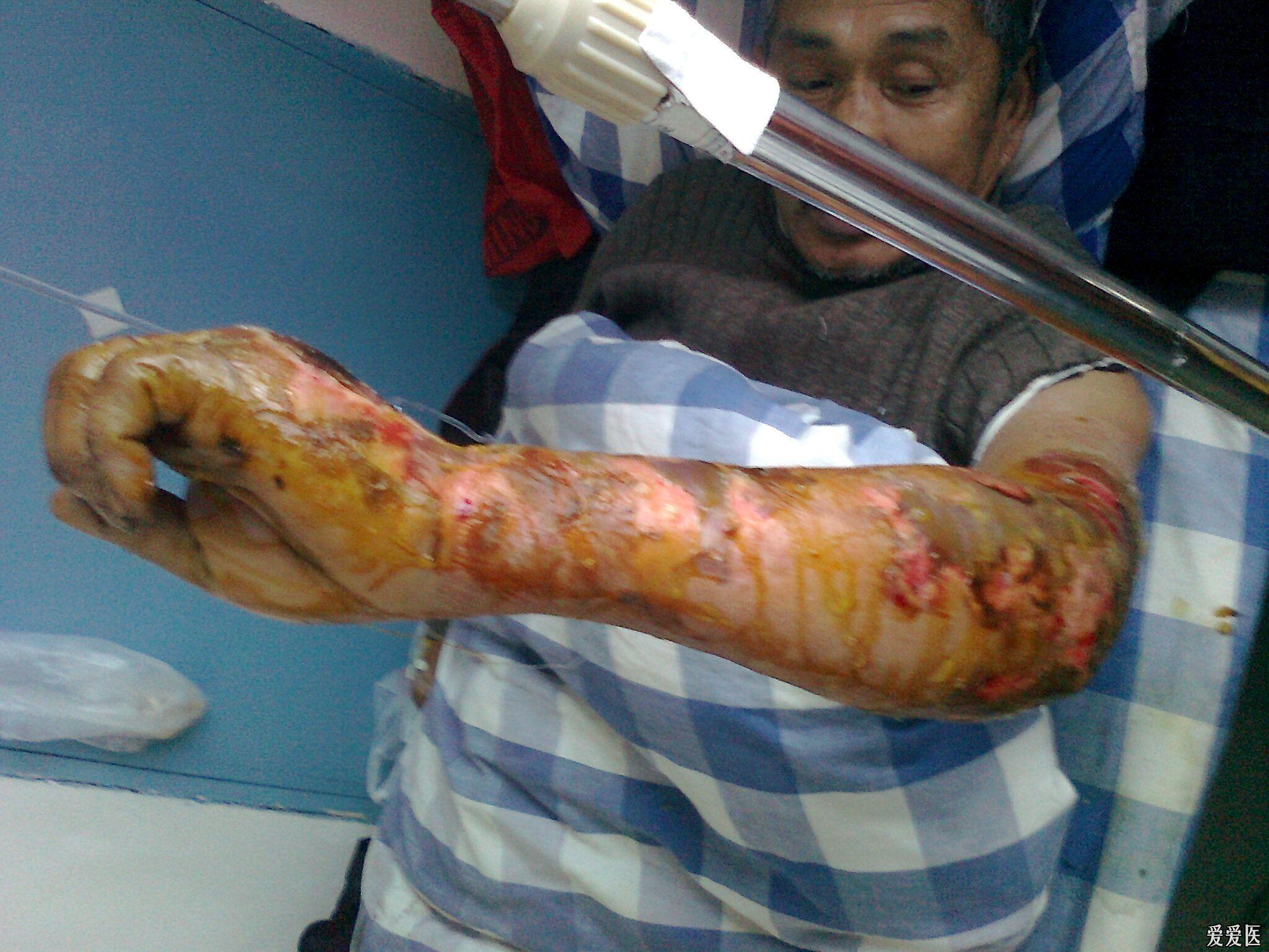 从未遇见的手外科感染