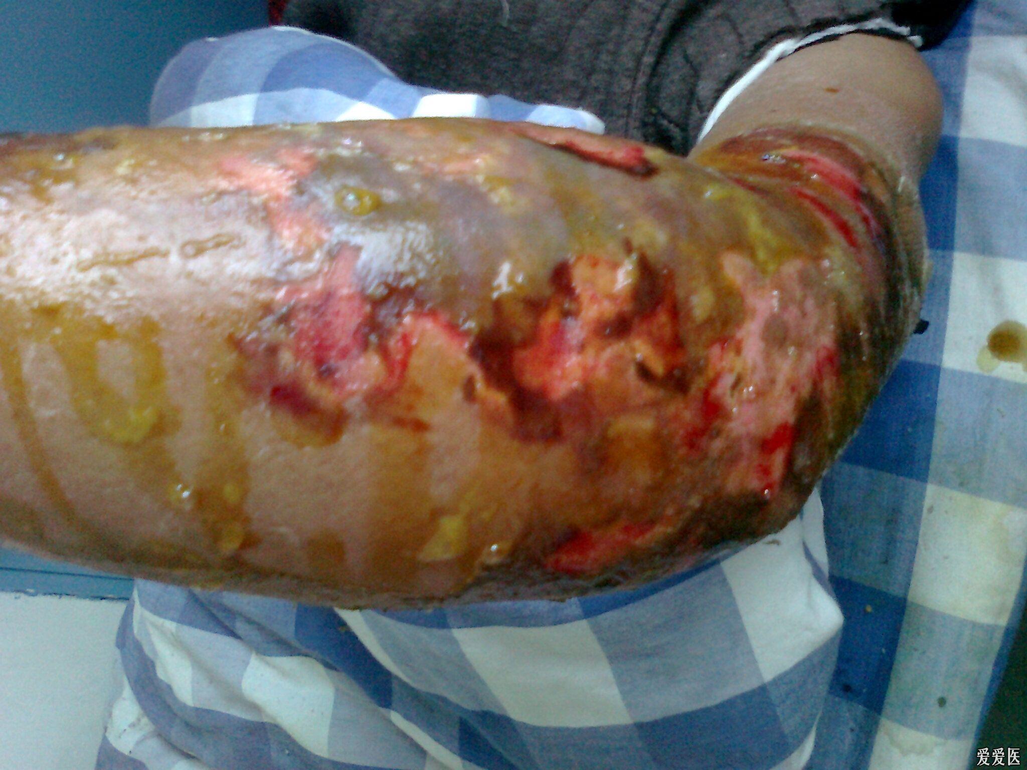 从未遇见的手外科感染