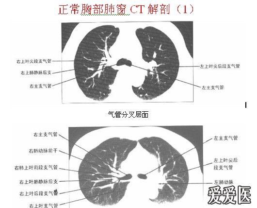 正常胸部ct解剖(肺窗,纵隔窗)【word版】