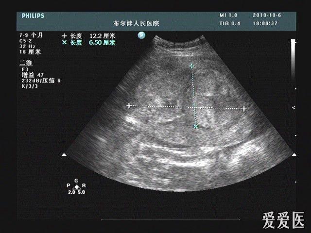 胎盘早剥超声诊断图片