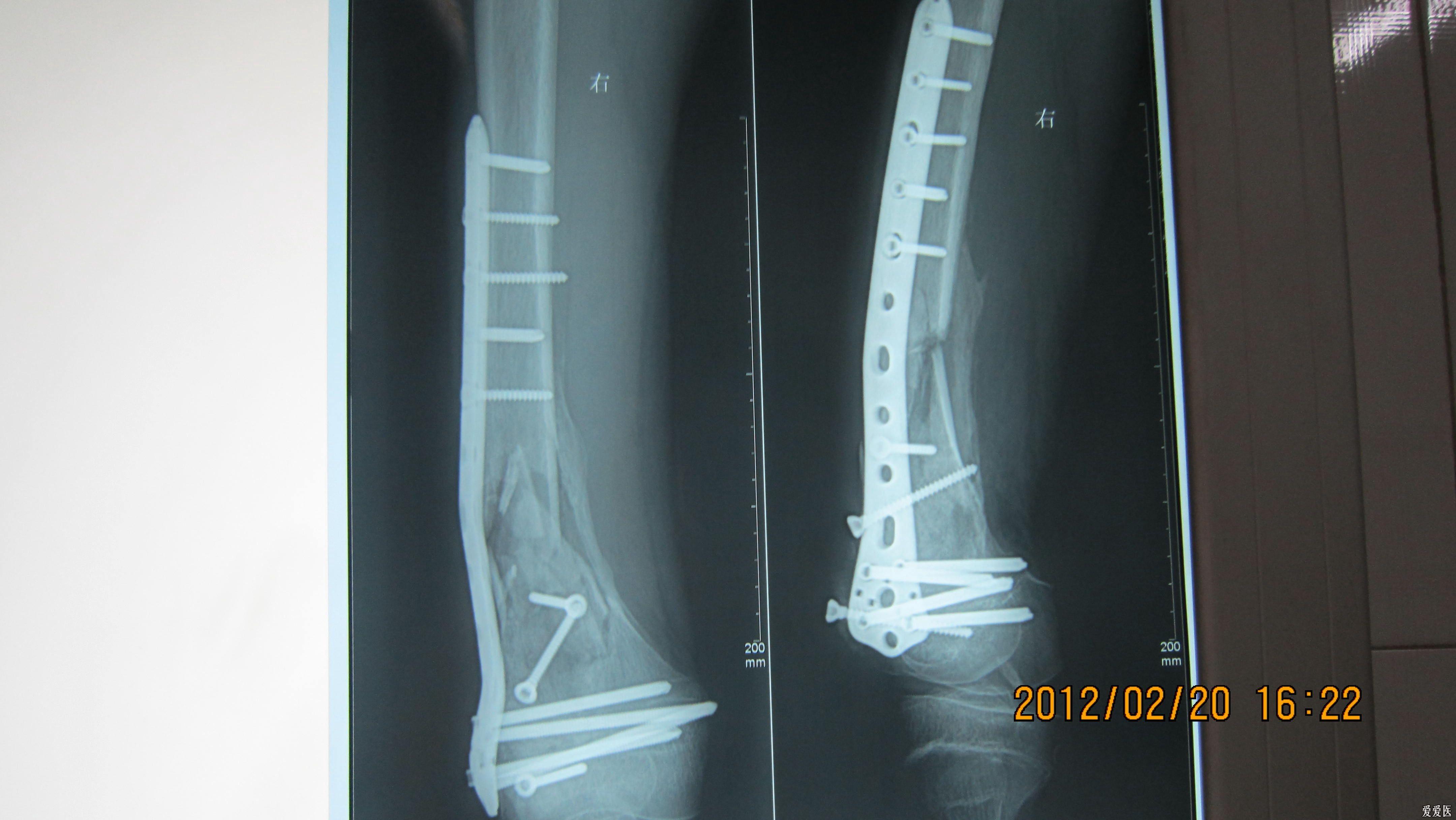 股骨髁骨折图片