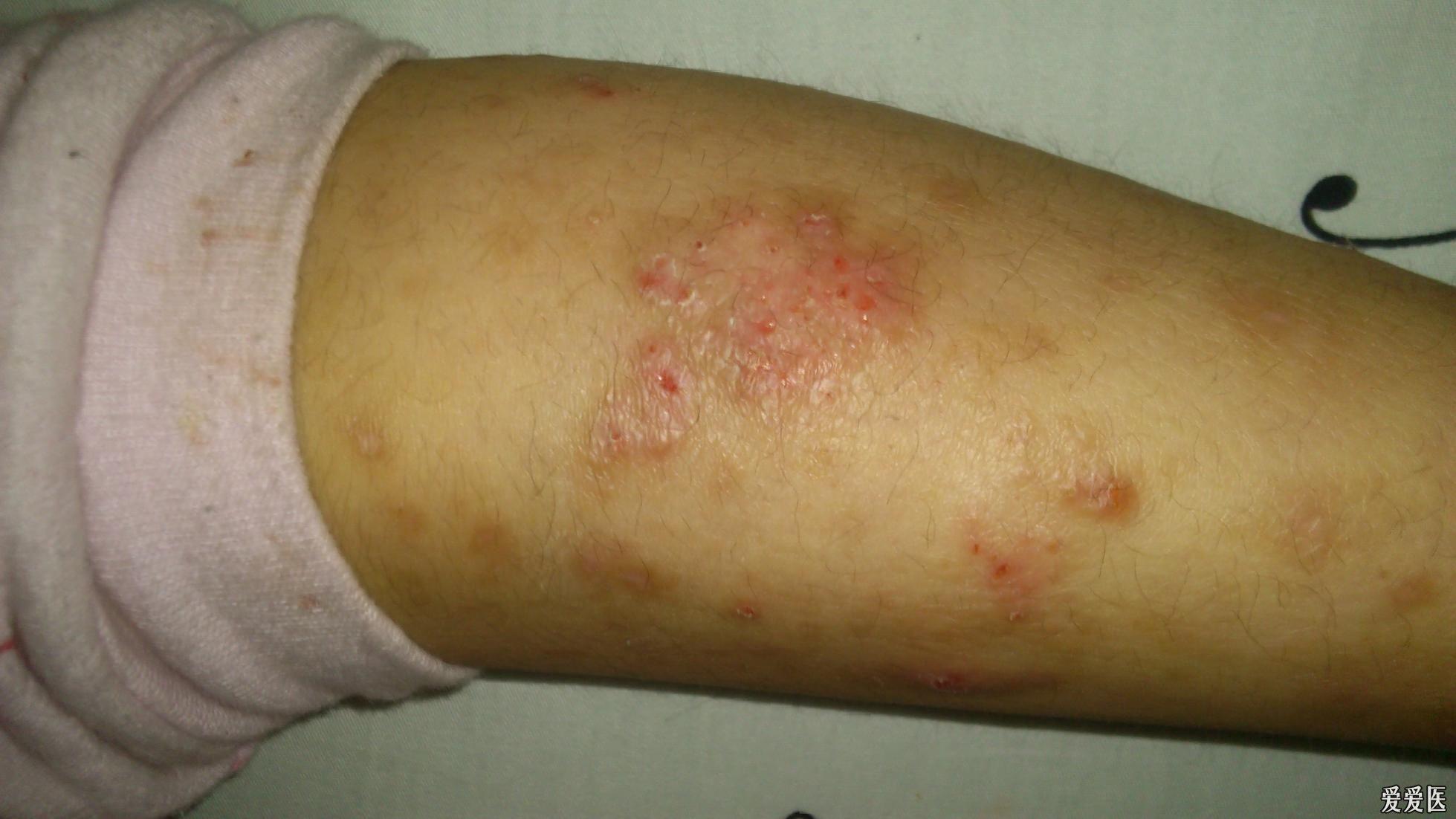 干燥性湿疹症状图片图片