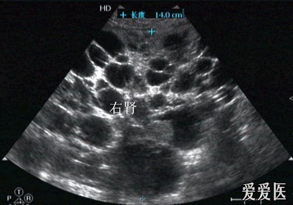 多囊肾的超声图片图片