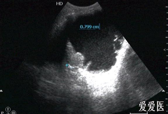 膀胱长息肉的彩超图片图片