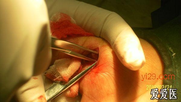 弹响指的手术治疗