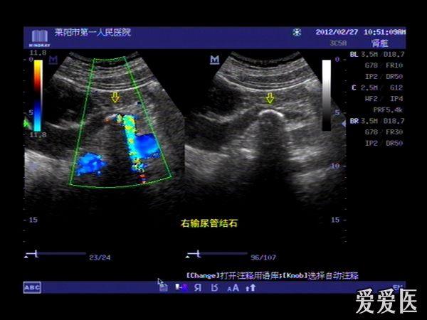 少見輸尿管雙側結石並雙側腎積水一例