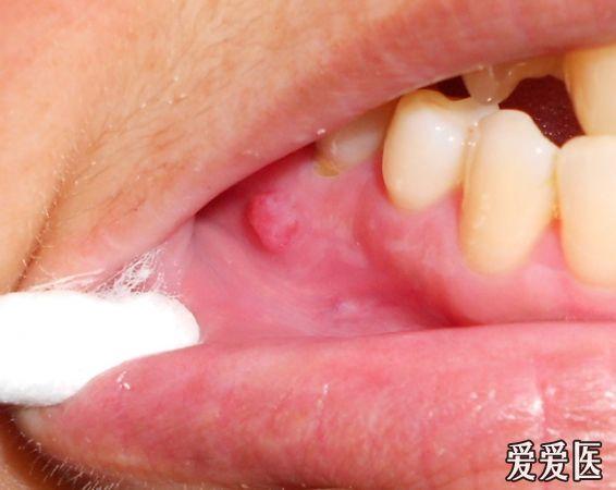 反复口腔溃疡两年余求教下颌黏膜上是什么