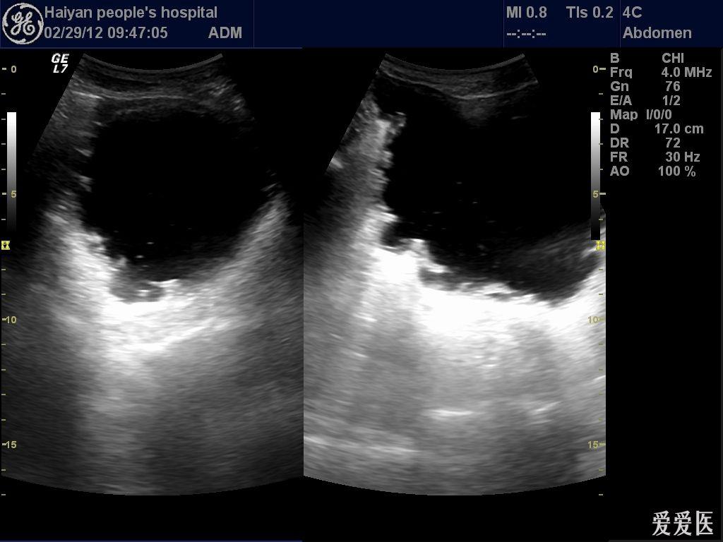 膀胱长息肉的彩超图片图片