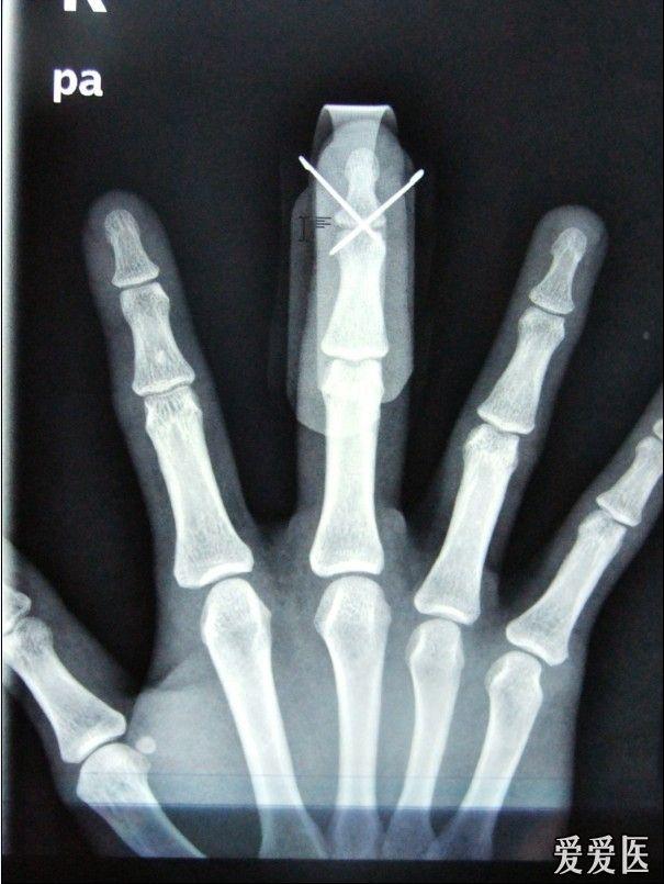 手指骨折手术两根克氏针固定后的疑问(有x片) - 骨