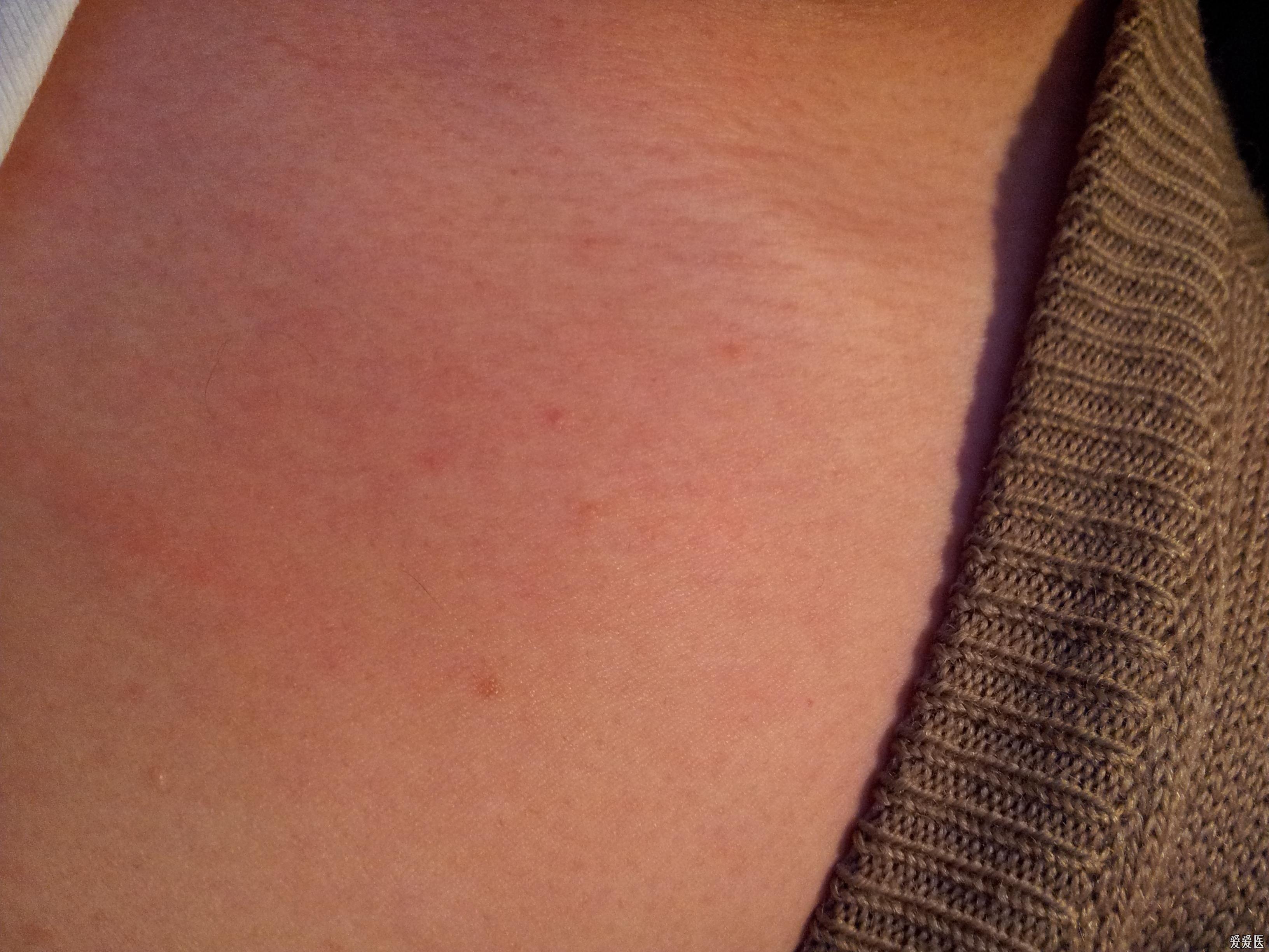 也没有弄清楚,现在偶尔手臂还是会有红色小丘疹出现,单个,伴轻度瘙痒