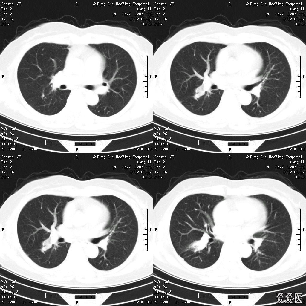 透視結論為陳舊性肺結核,近日複查cr,發現右肺門結構紊亂,遂做ct檢查