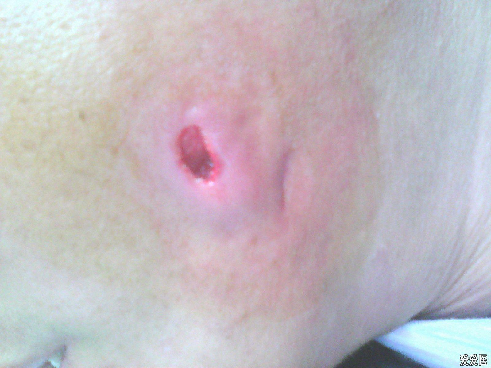 并行发生,检查可见左下颌第三磨牙萌出不全,有龈瓣覆盖,盲袋形成