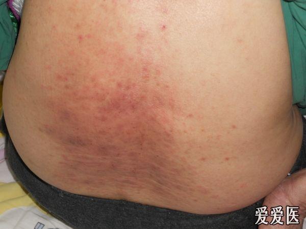 老年女性,考虑湿疹并真菌感染,抗真菌效果欠佳