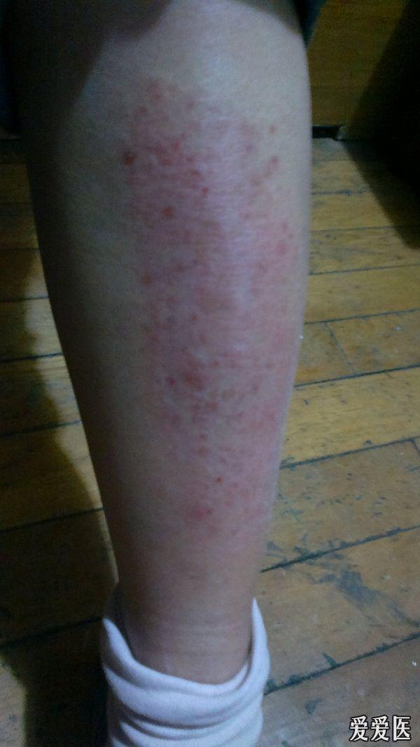 看图识病———胫前黑斑