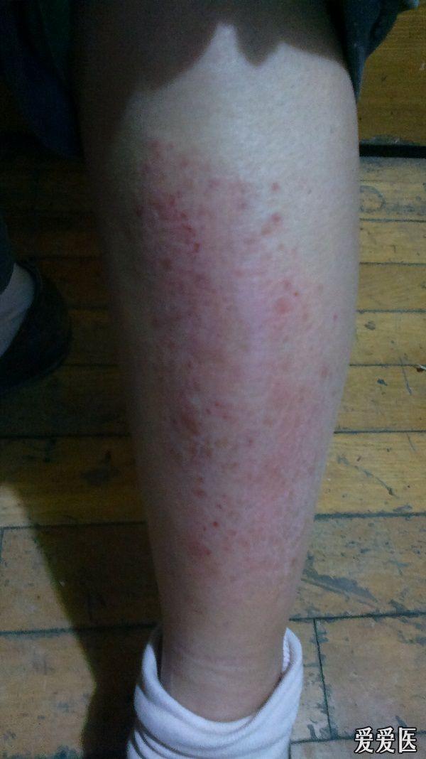 既往2型糖尿病15年余,降糖用胰岛素控制在3.8——11.8之间.高血