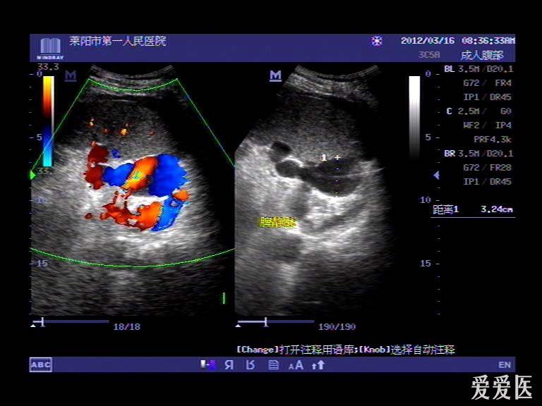 脾静脉超声图图片